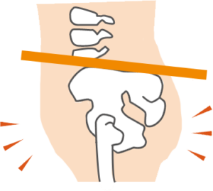 後傾した骨盤