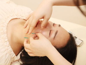 美容鍼の施術の様子